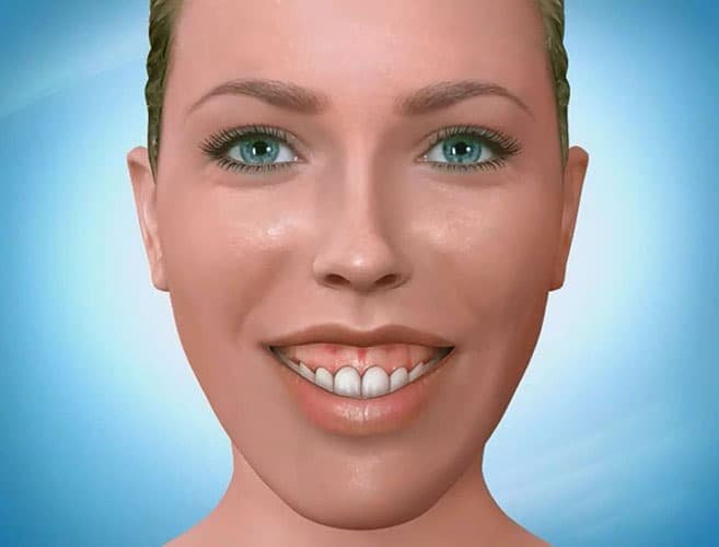 الابتسامة-اللثوية
