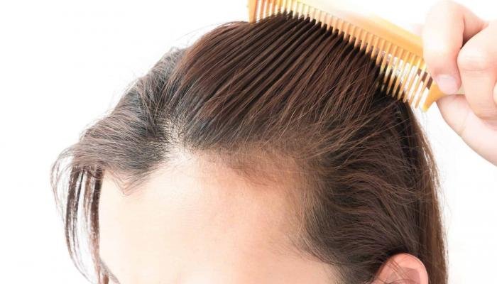 دكتورة-علاج-تساقط-الشعر-ينبع