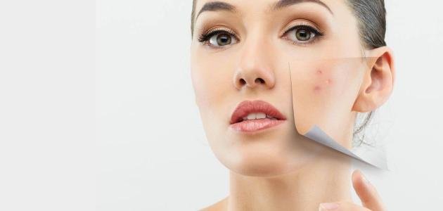 طرق-التخلص-حب-الشباب