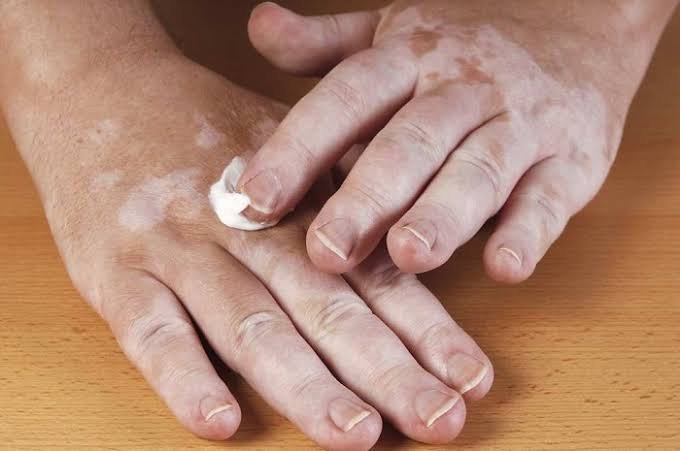 دكتور-لعلاج-البهاق-في-جدة