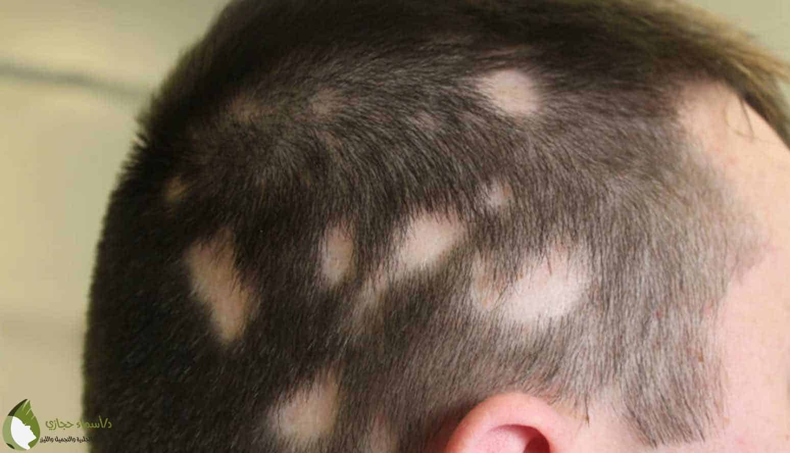دكتور-علاج-مرض-الثعلبة-جدة
