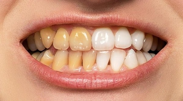 تبييض-الاسنان-الزوم-الفلاش