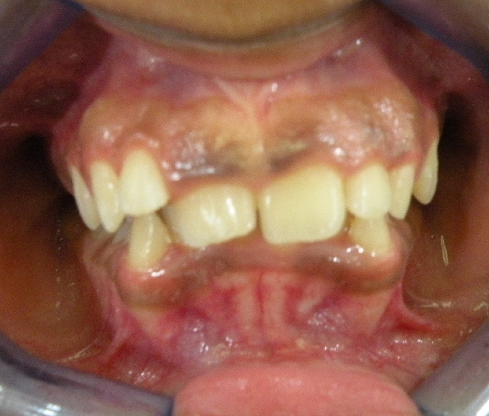 before